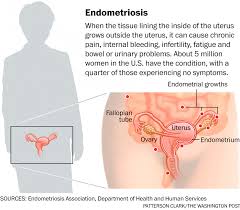 Learn more about the types, symptoms, causes, diagnosis, stages, treatment, and. Pathophysiology And Clinical Presentation Endometriosis