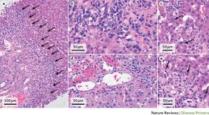Treatment for autoimmune hepatitis includes medication to suppress, or slow down, an overactive immune system. Autoimmune Hepatitis Nature Reviews Disease Primers