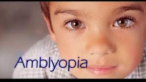 Image result for Amblyopia