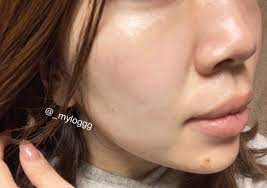 一回で意味ある 韓国でのほくろ シミ取りの効果 ビフォーアフター公開 衣の美容日記 韓国スキンケア シミの除去 美容