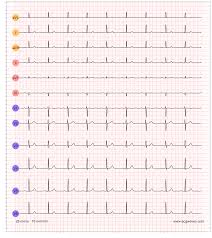 Image result for Atrioventricular Block