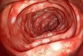 Image result for Ulcerative Colitis