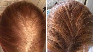 The process irradiates photons in scalp tissue, resulting in photons being absorbed into weaker hair follicles and promoting hair growth. Irestore Laser Hair Growth System Fda Cleared Hair Loss Treatment Irestore Hair Growth System