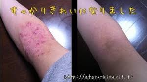 アトピー完治 アトピー スキンケア アレルギー性鼻炎