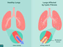 Cystic fibrosis (cf) is a genetic disorder, which means you get if from your parents at birth. How Cystic Fibrosis Is Treated