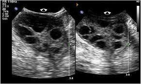 Ovarian cancer screening is not actually recommended for people at an average risk of developing the condition. Colour Doppler Evaluation Of Uterine And Ovarian Blood Flow In Patients Of Polycystic Ovarian Disease And Post Treatment Changes Clinical Radiology