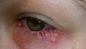 A herpes virus that causes cold sores and fever blisters in and around the mouth. Eye Herpes Pictures Symptoms And Types