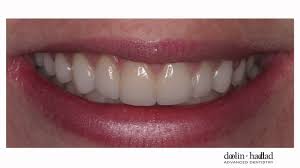 My Porcelain Veneers Are So Natural Looking I Love Them Youtube