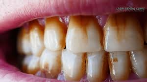Nobody wants to lose the natural white smile that they have, but a condition rub a part of the orange peel on the teeth to get rid of the stains caused by drinking coffee. How To Get Rid Of Teeth Discoloration Lasry Dental Clinic