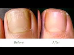 Conditions hair and detangles 20. Apple Cider Vinegar For Toenail Fungus Key Pro Reviews Youtube