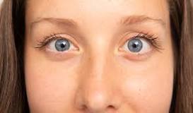 Image result for why do eyes go in 2 different directions in adults treatment