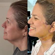 Has anyone had Q lift please ? Just starting my research