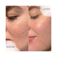 JULIE RN•Laser Tattoo Removal (@newyou_aesthetics) • Instagram photos and  videos