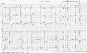 This test records the electrical activity of. Premature Ventricular Contraction An Overview Sciencedirect Topics