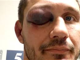 Matt Mitrione Filing Grievance to Have Travis Browne Loss Overturned