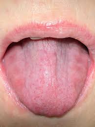 Image result for lichen planus on tongue)