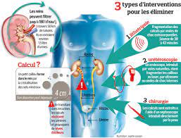 Check spelling or type a new query. Des Procedures Simplifiees Contre Les Calculs Renaux