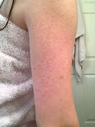Image result for Keratosis pilaris