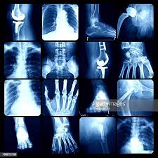 7 456 X Ray Bones Photos And Premium High Res Pictures Getty Images
