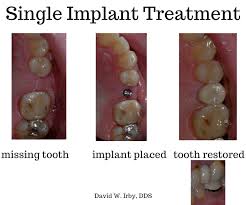 Average price for teeth implants in 2021 is $2000. Dental Implants Roanoke Va My Roanoke Dentist