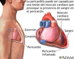 Pericarditis Despues De Un Ataque Cardiaco Medlineplus Enciclopedia Medica