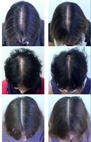 Other dietary supplements, including herbal supplements, may likewise lead to hair loss, especially at high dosages. New Research Into Curing Women S Hair Loss Through Diet