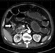 When colon cancer is detected in its early stages, it may not have even caused symptoms. Computed Tomography Scan Showing A Hepatic Flexure Colon Cancer With An Download Scientific Diagram