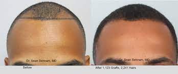 Long hair men continue to look fashionable and trendy. Men S African American Hair Transplant Dr Sean Behnam