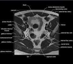 Anatomy of the thorax, heart, abdomen and pelvis the following video will go through normal abdominal anatomy on ct imaging. Mri Pelvis Anatomy Free Male Pelvis Axial Anatomy