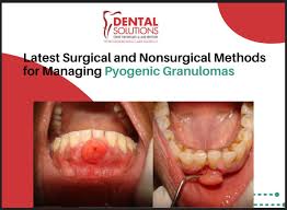 Image result for Pyogenic Granuloma