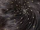 Lice In Hair Vs Dandruff
