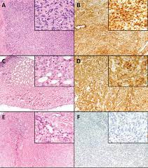 Treatment may include surgery, radiation therapy or chemotherapy. B7 H1 Expression In Malignant Pleural Mesothelioma Is Associated With Sarcomatoid Histology And Poor Prognosis Journal Of Thoracic Oncology