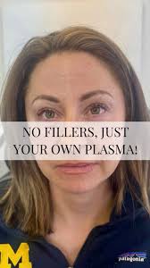 Say goodbye to under-eye hollows with Cellenis PRP Filler! ✨ , Using your  body’s own regenerative power, this treatment restores volume, smooths fine  lines, and gives a refreshed, youthful ...
