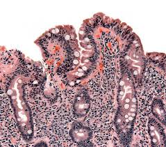 Celiac disease is a serious condition in which the immune system attacks the small intestine in response to eating gluten. Coeliac Disease Wikipedia