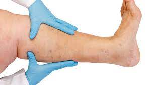 En trombosis arteriales, el fv. Tratamiento De Trombosis Arterial Y Venosa Dra Denisse Noe Carranza