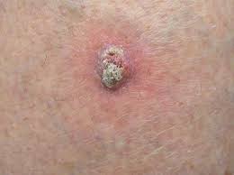 Sometimes the skin on the top of the tumor breaks open and bleeds. Symptoms Of Merkel Cell Carcinoma