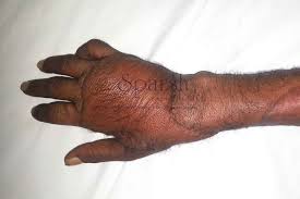 Image result for Hand Injury
