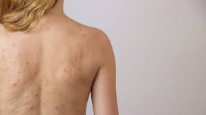 Como Combatir El Acne En La Espalda Con Remedios Caseros