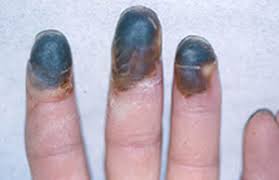 Buerger S Disease Johns Hopkins Vasculitis Center