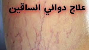 يمكن علاج حالات دوالي الساقين باستخدام طرقٍ متعدّدة، وعادةً ما يجري ذلك في عيادة الطبيب دون الحاجة لدخول المستشفى، ومن الجدير بالذكر أنّ دوالي الساقين التي تحدث أثناء الحمل (بالإنجليزية. Ø¹Ù„Ø§Ø¬ Ø¯ÙˆØ§Ù„ÙŠ Ø§Ù„Ø³Ø§Ù‚ÙŠÙ† Youtube