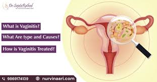 Image result for Vaginitis