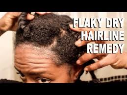 Natural Hair Flaky Dry Hairline Scalp Remedy Scalp Psoriasis Beautycutright Click H Psoriasis Remedies Scalp Scalp Psoriasis Treatment Scalp Psoriasis