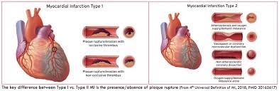 Pulmcrit Acute Infection Myocardial Infarction How Afraid Should We Be