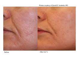 Shrink Large Pores T Douglas Gurley Md