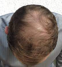 Der arzt führt die behandlung selber durch. Haartransplantation Forum Haartransplantation Allgemein Haarausfall Und Sehr Dunnes Naturhaar