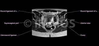 Check spelling or type a new query. Mri Of The Female Pelvis