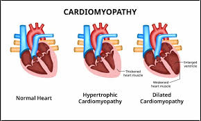 Image result for Cardiomyopathy