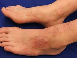 Dead and dry like dandruff skin from foot , back of hands, whole body looks white and hair loss, dandruff. Foot Rash Causes Symptoms Treatment