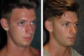 Check spelling or type a new query. New York Rhinoplasty Specialist Dr Andrew Jacono Male Rhinoplasty Before And After Patient Photos Rhinop Rhinoplasty Rhinoplasty Before And After Nose Job
