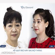 Treo Mày E-Har Cao Cấp Tại Trung Tâm Thẩm Mỹ Sky Diamond